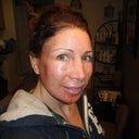 2 days after procedure-feeling good-just look pretty scarey-have to go back to work tomorow