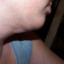 loose skin