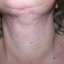 uneven fat