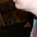 loose skin