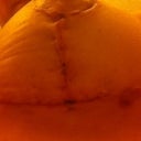 3 days post op