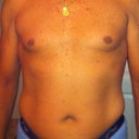 Right before surgery....What a mess!