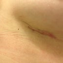 3 weeks right scar