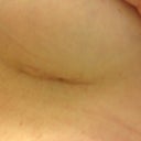 3 weeks left scar