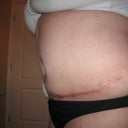 7 weeks post-op