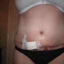 7 weeks post-op
Looky Looky I'm getting abb's