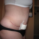 7 weeks post-op
Looky Looky I'm getting abb's