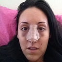 Day two after surgery