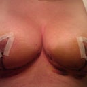 1 week Post Op