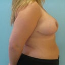 8 weeks post op2
