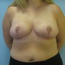 8 weeks post op5