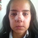 Day 4... looking like a chipmunk! still with my nose really swollen :(