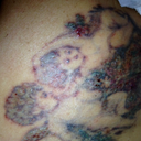 My bandage fell off- this is the morning after my 3rd treatment- it looks dark and blistery.