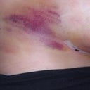 bruising