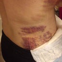 more bruising