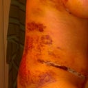 lots of bruising...