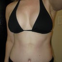 5 weeks post op. Rash is going away slowly.