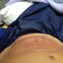 After suction and gel pad were removed