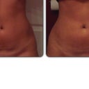 Morning before procedure/after procedure- day 1... swollen, but can already see the lumps beginning to smooth out
