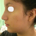 12 days after surgery