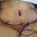 Day 4 and 1st post visit...this is my new tummy!! Mind you I am super swollen! But, you can see the results already!!!!