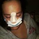 night of surgery.