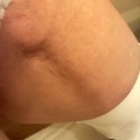 This is the inside of my left thigh. The bump appears to be close to where the incision for the lipo cannula was made. This is 4 wks out from surgery
