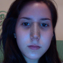 10 days post op! I got my cast removed two days ago and now I have this tape on my nose.
