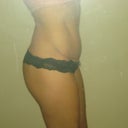 My underwear is pulled down in this pic...usually my scar is completly hidden.