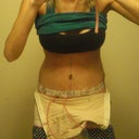 4 days after...i wanted to show the garment and drains...i never seen a pic of this before surgrey