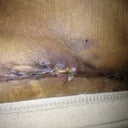 Right side. It's about the size of the tip of my pinky but in my brain it's a HUGE gaping hole!