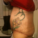 Is this just swelling see the bulge around belly button