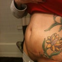 3 weeks tomorrow bulge? Swelling?? Ugh