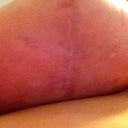 2 month post op