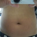 Same day after procedure.  My stomach is swollen, but you get the general idea.