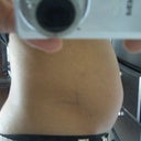 Same day after procedure.  My stomach is swollen, but you get the general idea.