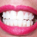 Progress of being on the 9th Invisalign tray. Look how it moved my bottom tooth that was behind the others.