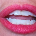 Progress of 9th Invisalign tray.  More to go... It's moving the front teeth but slowly.