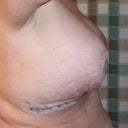 Post op day 1 right side