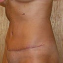 Left side view - 6 weeks