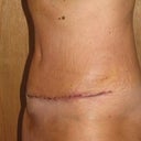 Left view - 10 days
