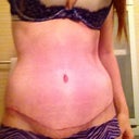 Incision at 5 weeks. Just started Bio Oil 8 days ago. :)