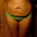 Before Tummy Tuck