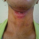 5 days post 8/10