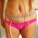 6 days post op