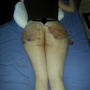 day 4 post op, so swole!