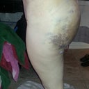 day 4 post op, kind of weird shaped, is this normal?