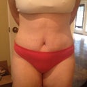 15 Days Post Op. Wanted to see how low my scar is, so I pulled out the lowest cut pair of undies I could find. So pleased with my scar placement and my results, although I'm still quite swollen.
