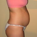 1 year after second child, 1 day before surgery