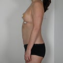 7 days post op perky